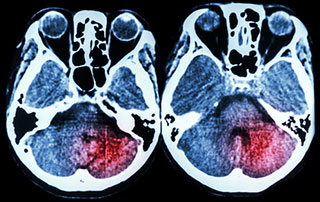 Phoenix-brain-injury-attorney Phoenix Brain Injury Lawyer